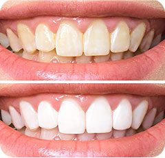 Blanqueamiento dental