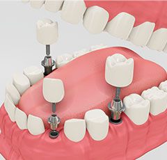 Implantes dentales